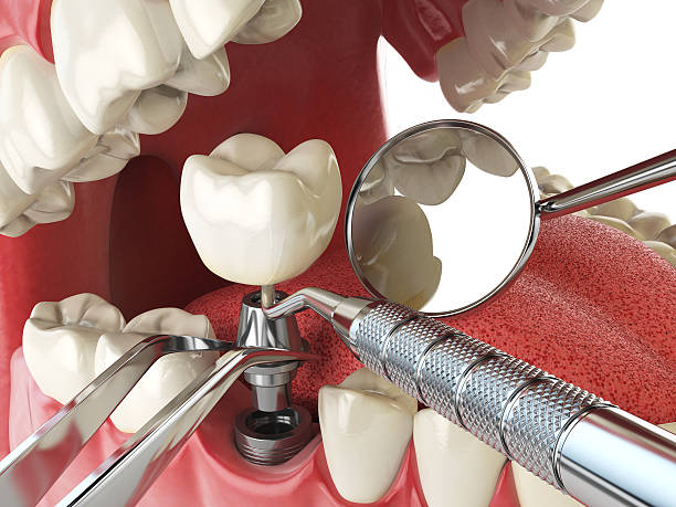 Best Emergency Dental Care for Sports Injuries in East Village, CT